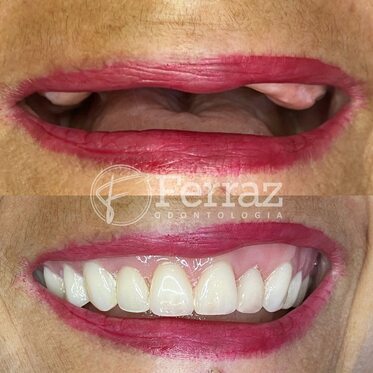 Prótese parcial removível